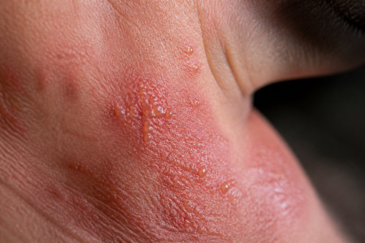 Allergie parfum symptômes et mécanismes de sensibilisation cutanée